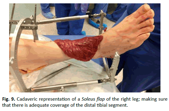 Orthopaedics-Trauma-Surgery-Related-Research-distal-tibial-segment