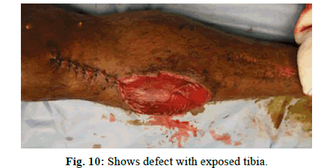 Orthopaedics-Trauma-Surgery-Related-Research-exposed-tibia