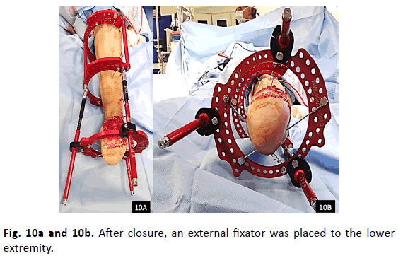 Orthopaedics-Trauma-Surgery-Related-Research-external-fixator