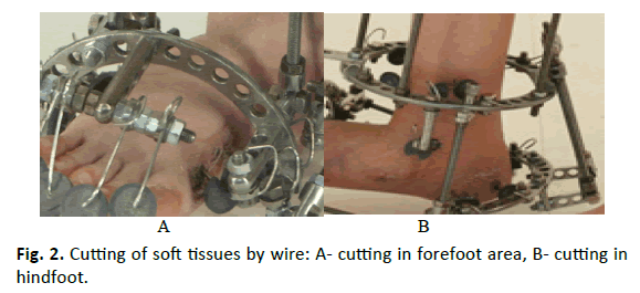 Orthopaedics-Trauma-Surgery-Related-Research-forefoot-area