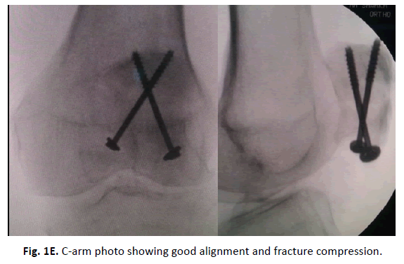 Orthopaedics-Trauma-Surgery-Related-Research-fracture-compression