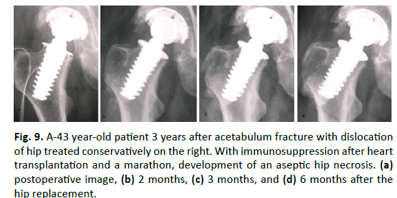 Orthopaedics-Trauma-Surgery-Related-Research-Spiron-prosthesis