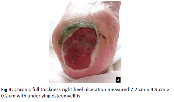 Orthopaedics-Trauma-Surgery-Related-Research-heel-ulceration