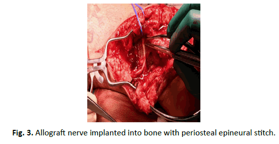 Orthopaedics-Trauma-Surgery-Related-Research-implanted-bone