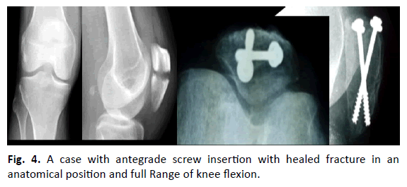 Orthopaedics-Trauma-Surgery-Related-Research-knee-flexion