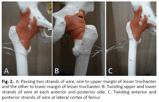 Orthopaedics-Trauma-Surgery-Related-Research-lesser-trochanter