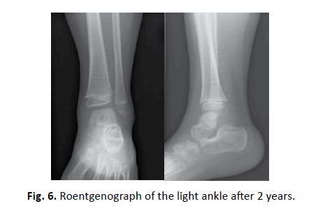 Orthopaedics-Trauma-Surgery-Related-Research-light-ankle-after