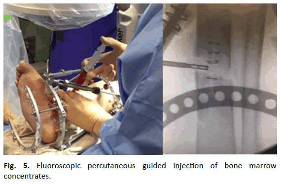 Orthopaedics-Trauma-Surgery-Related-Research-percutaneous