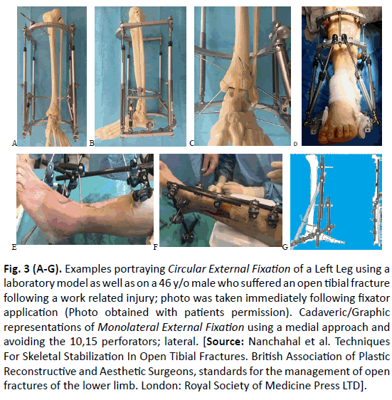 Orthopaedics-Trauma-Surgery-Related-Research-portraying-Circular-External