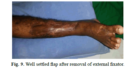 Orthopaedics-Trauma-Surgery-Related-Research-removal-external-fixator