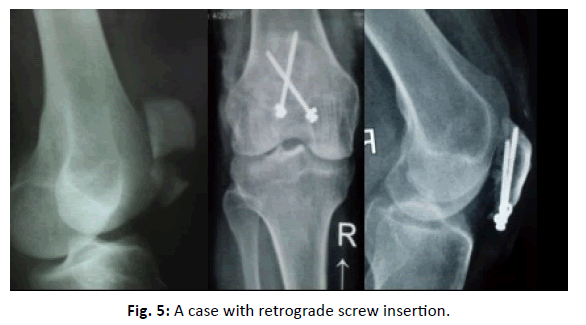 Orthopaedics-Trauma-Surgery-Related-Research-retrograde-screw