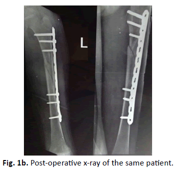 Orthopaedics-Trauma-Surgery-Related-Research-same-patient