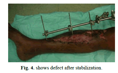 Orthopaedics-Trauma-Surgery-Related-Research-shows-defect-after