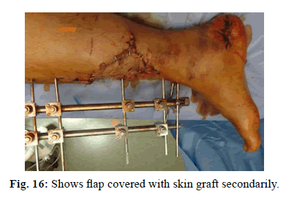 Orthopaedics-Trauma-Surgery-Related-Research-skin-graft-secondarily