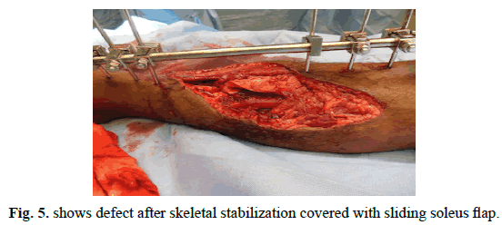 Orthopaedics-Trauma-Surgery-Related-Research-sliding-soleus-flap