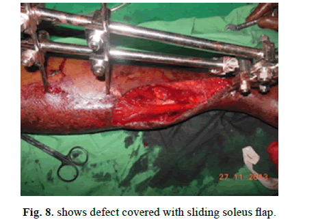 Orthopaedics-Trauma-Surgery-Related-Research-sliding-soleus-flap