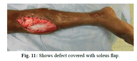 Orthopaedics-Trauma-Surgery-Related-Research-soleus-flap