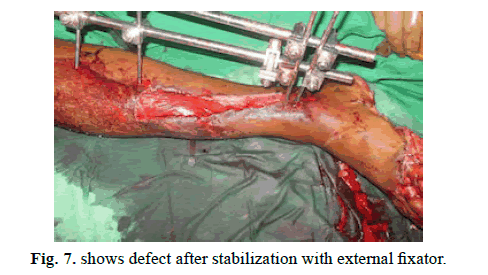 Orthopaedics-Trauma-Surgery-Related-Research-stabilization-external-fixator