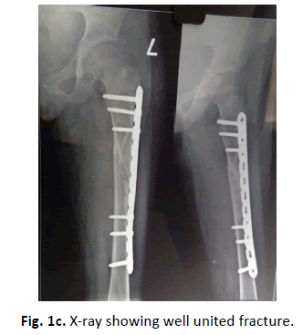 Orthopaedics-Trauma-Surgery-Related-Research-united-fracture