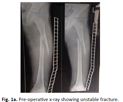Orthopaedics-Trauma-Surgery-Related-Research-unstable-fracture