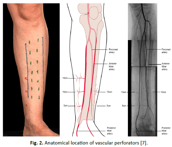 Orthopaedics-Trauma-Surgery-Related-Research-vascular-perforators