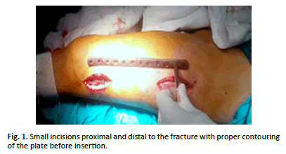 Orthopaedics-Trauma-Surgery-Small-incisions-proximal