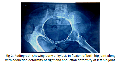 Orthopaedics-Trauma-Surgery-abduction-deformity-left-hip-joint