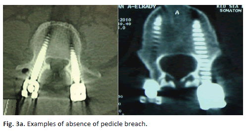 Orthopaedics-Trauma-Surgery-absence-pedicle-breach