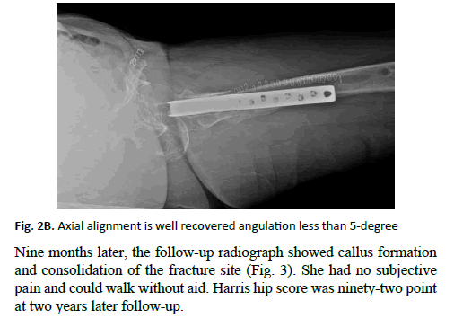 Orthopaedics-Trauma-Surgery-angulation