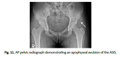 Orthopaedics-Trauma-Surgery-apophyseal-avulsion-ASIS