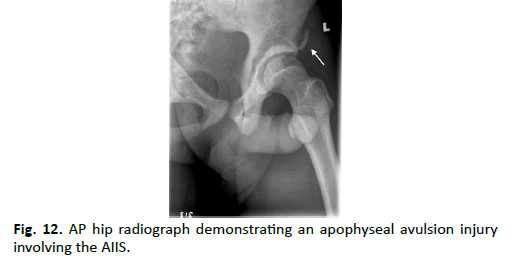 Orthopaedics-Trauma-Surgery-apophyseal-avulsion-injury