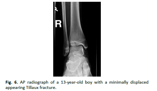 Orthopaedics-Trauma-Surgery-appearing-tillaux-fracture