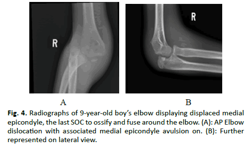 Orthopaedics-Trauma-Surgery-associated-medial-epicondyle