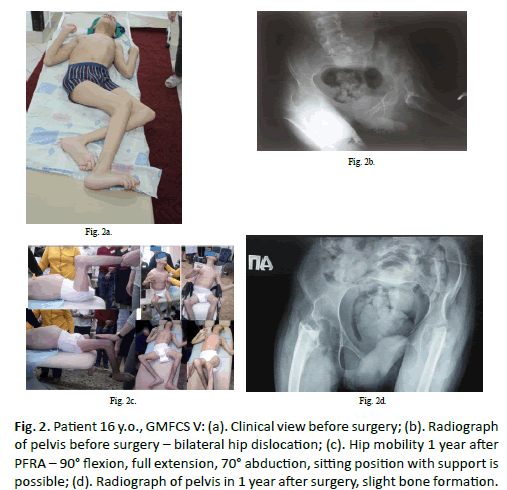 Orthopaedics-Trauma-Surgery-bilateral-hip-dislocation