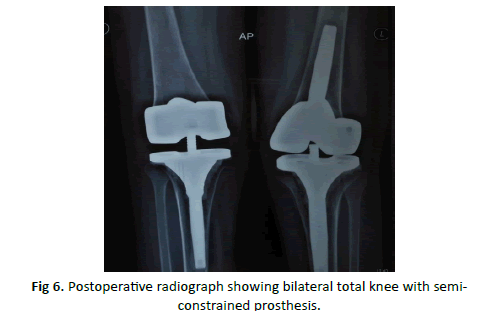 Orthopaedics-Trauma-Surgery-bilateral-total-knee-semiconstrained-prosthesis