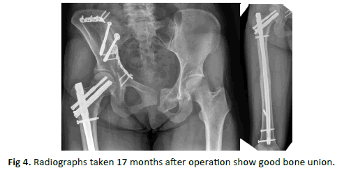 Orthopaedics-Trauma-Surgery-bone-union