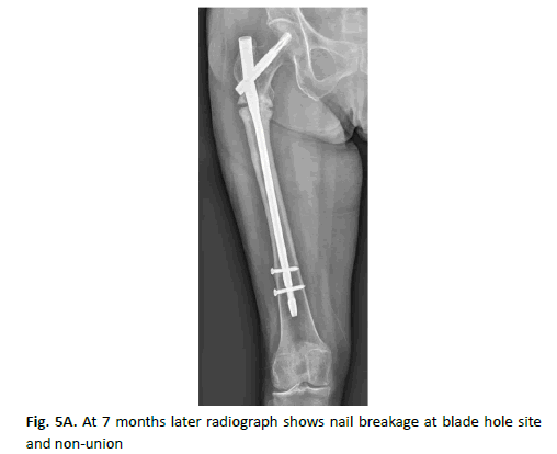 Orthopaedics-Trauma-Surgery-breakage