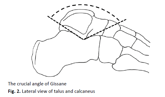 Orthopaedics-Trauma-Surgery-calcaneus