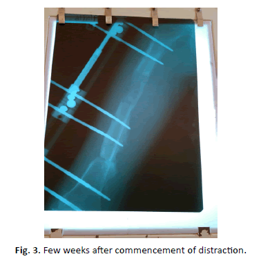 Orthopaedics-Trauma-Surgery-commencement-distraction