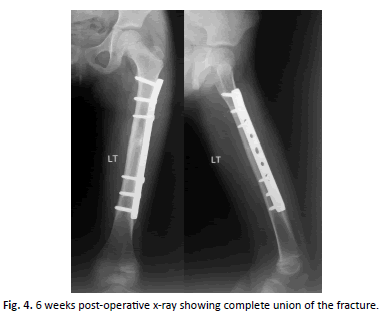 Orthopaedics-Trauma-Surgery-complete-union-fracture