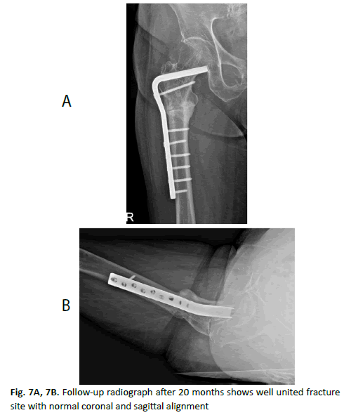 Orthopaedics-Trauma-Surgery-coronal