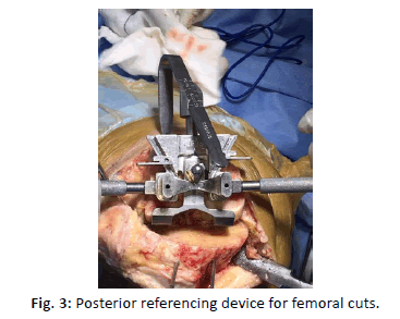 Orthopaedics-Trauma-Surgery-device-femoral-cuts