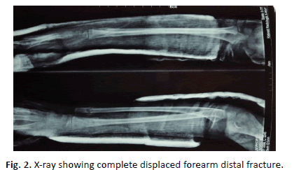 Orthopaedics-Trauma-Surgery-distal-fracture