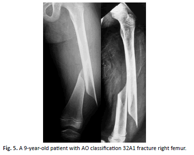 Orthopaedics-Trauma-Surgery-fracture-right-femur