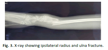 Orthopaedics-Trauma-Surgery-ipsilateral