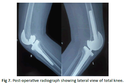 Orthopaedics-Trauma-Surgery-lateral-view-total-knee