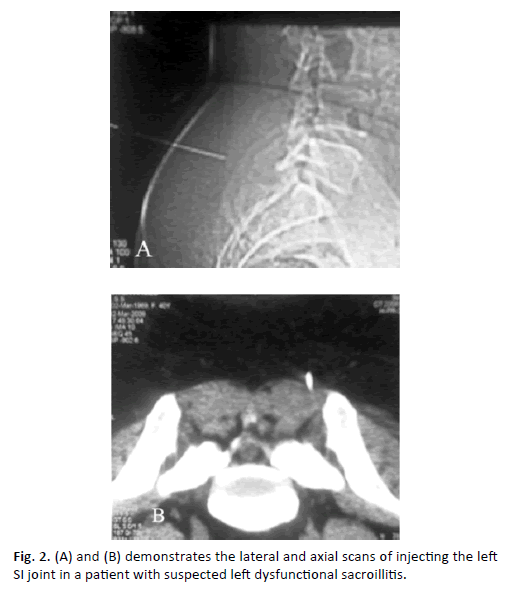 Orthopaedics-Trauma-Surgery-left-dysfunctional-sacroillitis