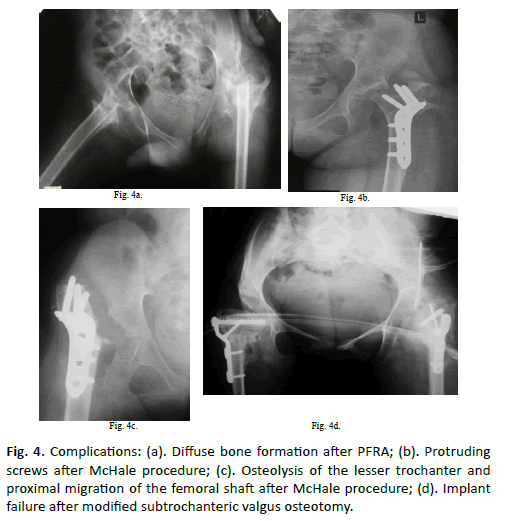 Orthopaedics-Trauma-Surgery-left-dysfunctional-sacroillitis