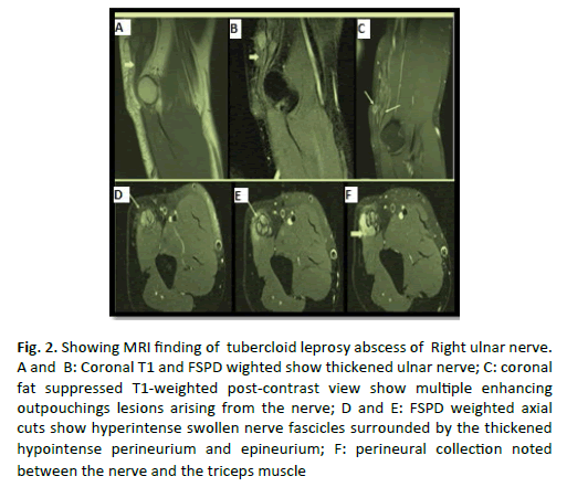 Orthopaedics-Trauma-Surgery-leprosy