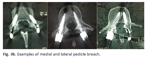 Orthopaedics-Trauma-Surgery-medial-lateral-pedicle-breach